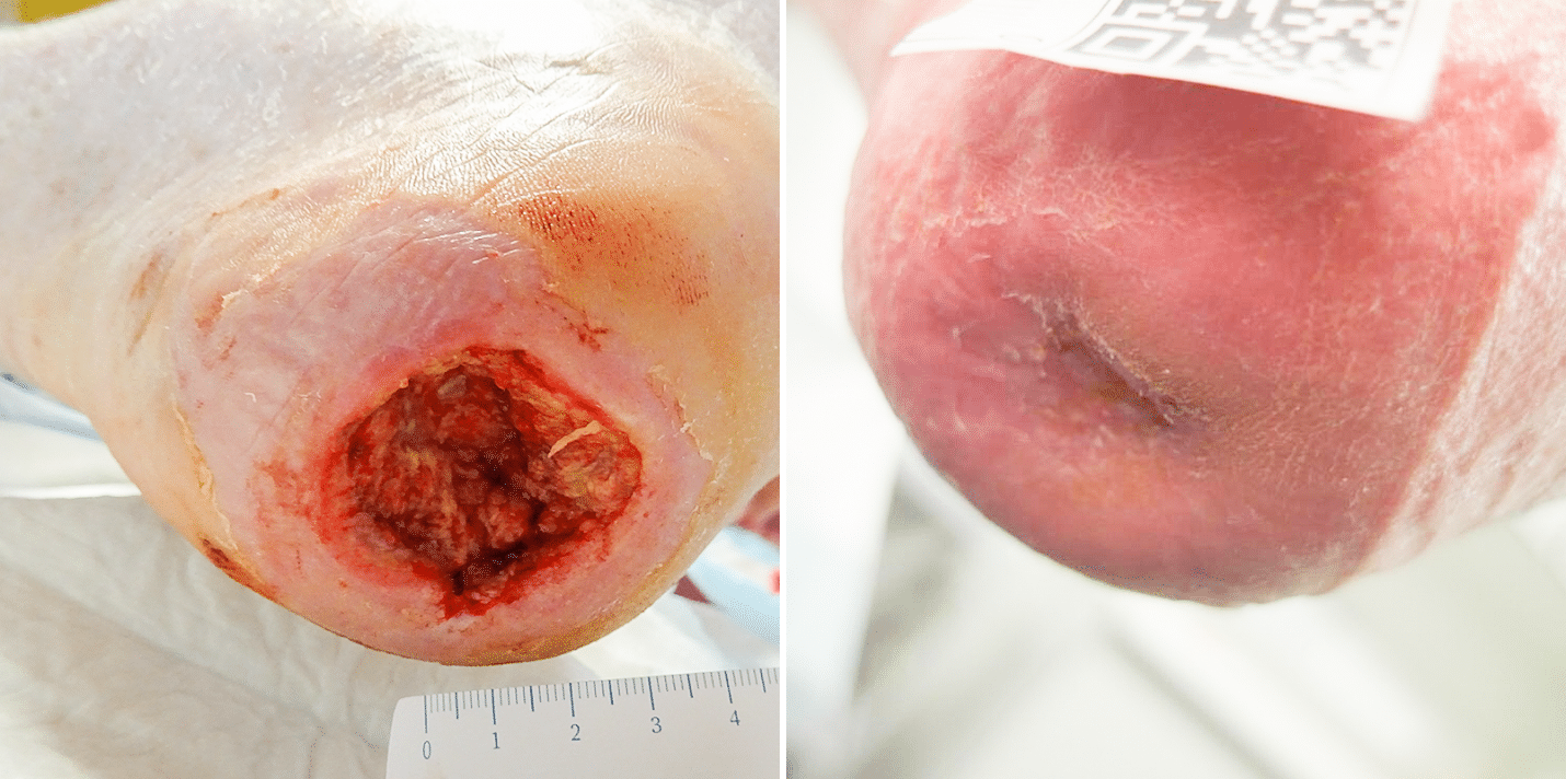 Heel ulcer probe to bone