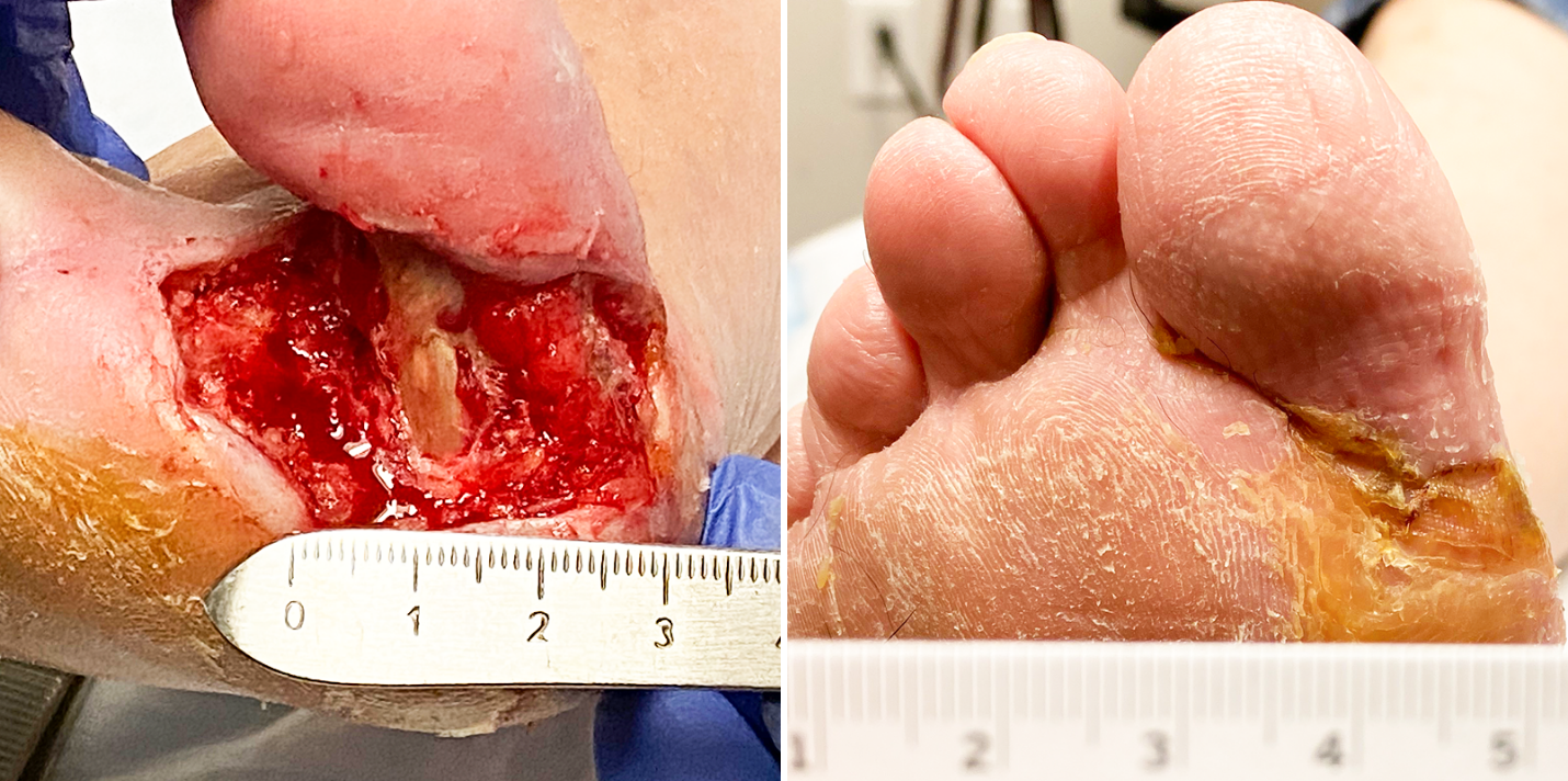 Diabetic foot ulcer exposed tendon
